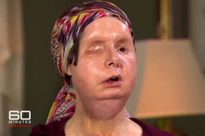 Charla Nash Face Reveal After Getting Attacked By Chimpanzee- Before Surgery Photos And More
