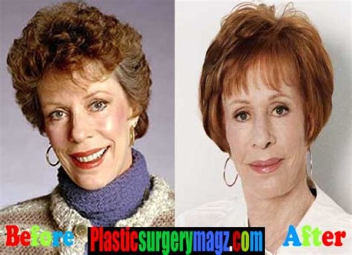 Did Carol Burnett Have Plastic Surgery? Fans Curious About Botox And Facelift