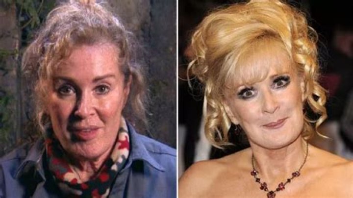 
Has Beverley Callard Had A Stroke? Illness And Face Lift Plastic Surgery Rumors 